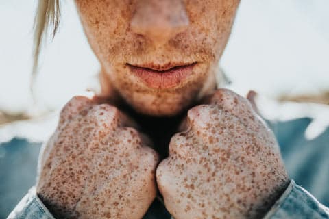 hyperpigmentation de la peau